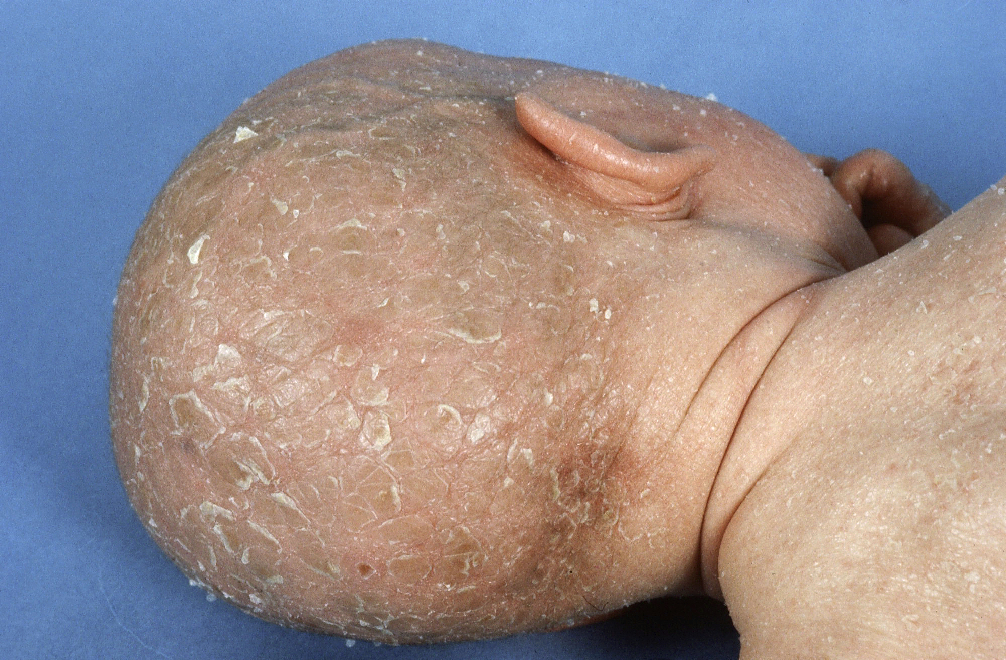 congenitale ichthyosiforme erythrodermie