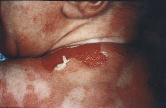 Bulleuize Congenitale Ichthyosiforme Erythrodermie